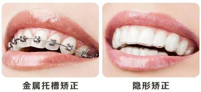 孩子牙齿不齐？“隐形矫正”来了！还给孩子自信与微笑！